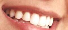 implantes-dentarios-sao-jose-dos-campos-1447971407